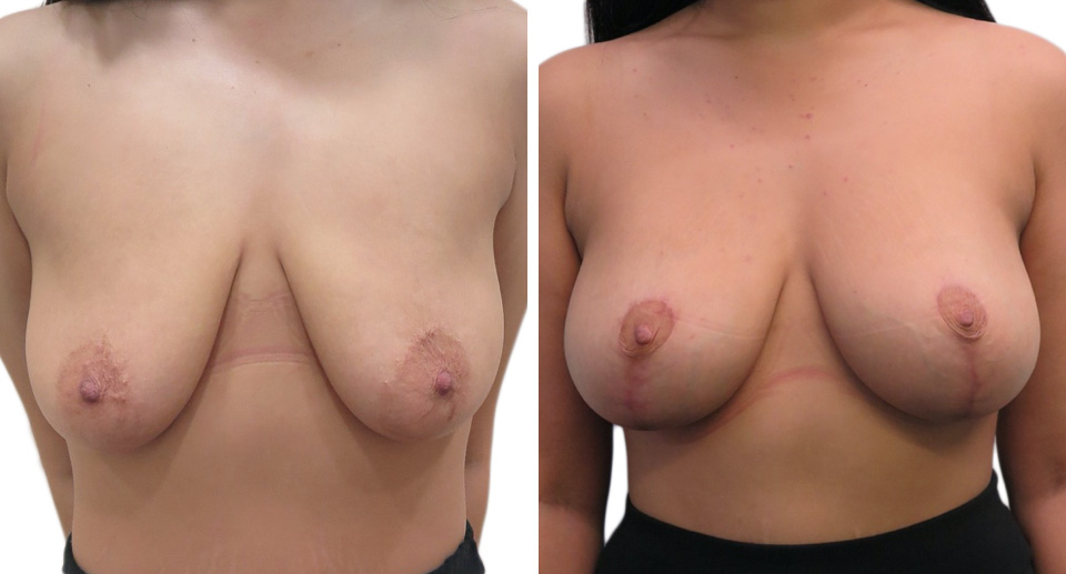 Breast Lift