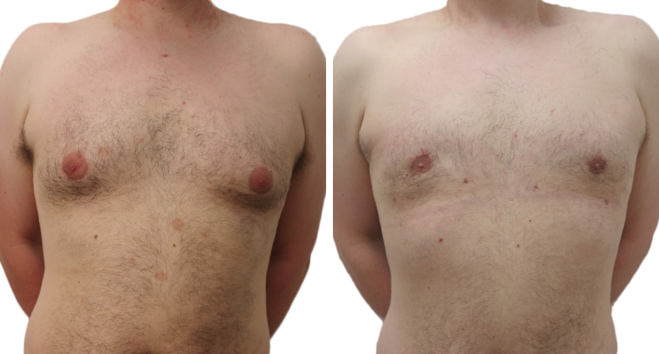 Male Breast Reduction