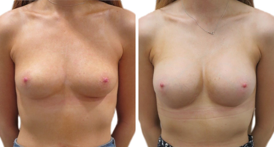 Breast Enlargement