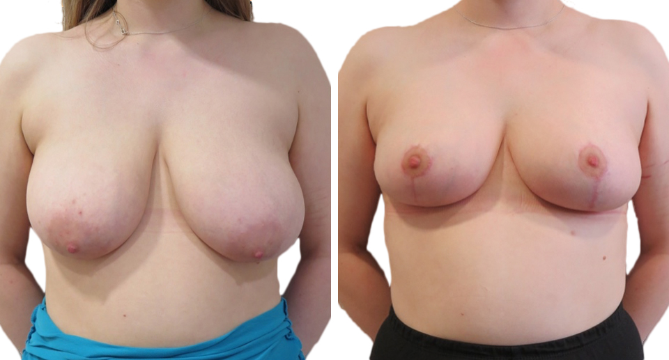 Breast Reduction