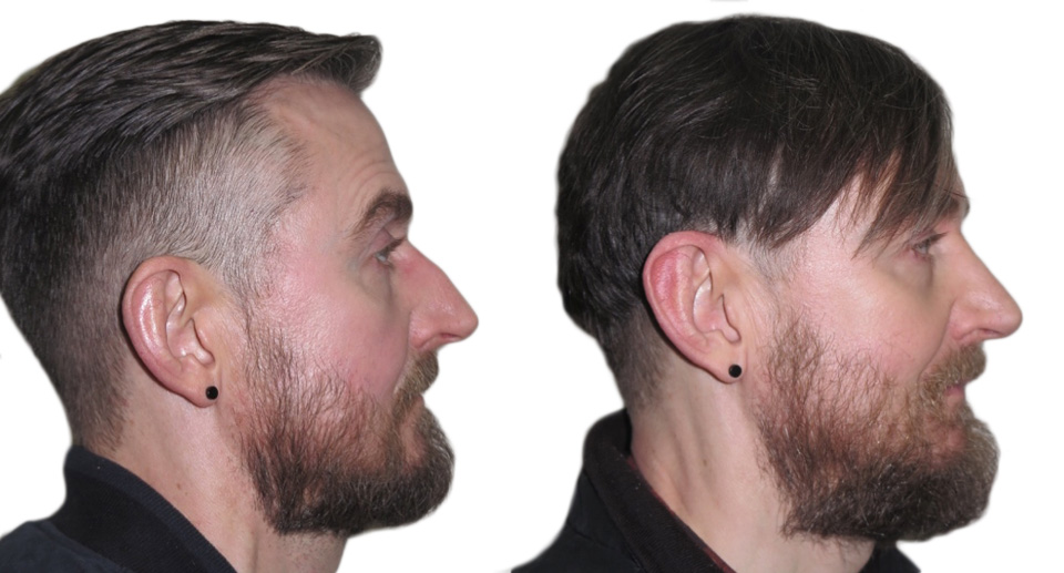 Nose Reshaping