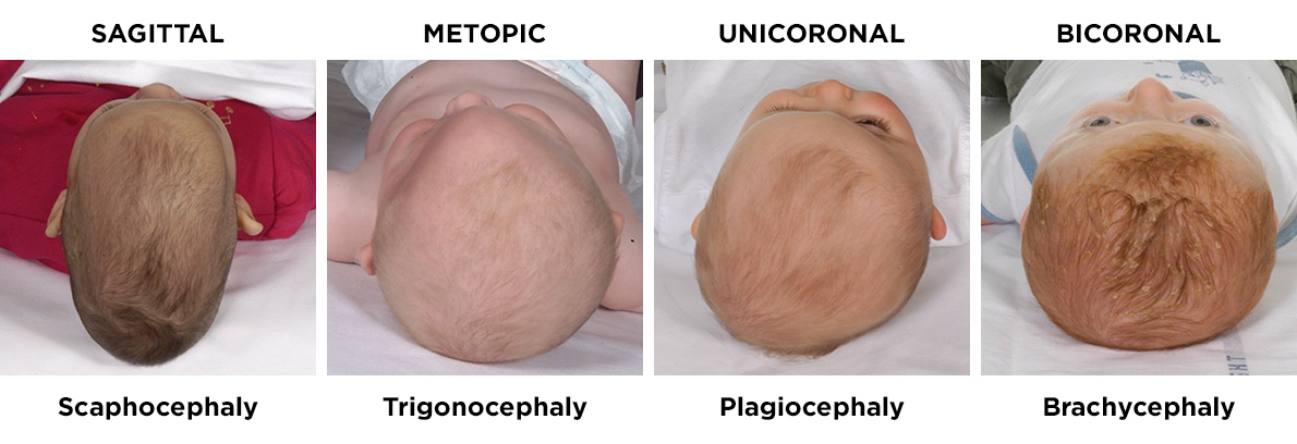 Headshapes in craniosynostosis