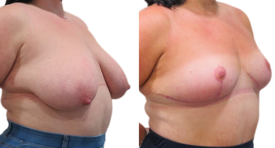 Breast Reduction