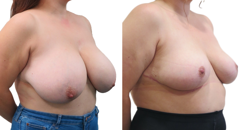 Breast Reduction