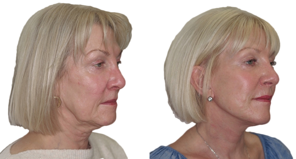 Facelift / Necklift