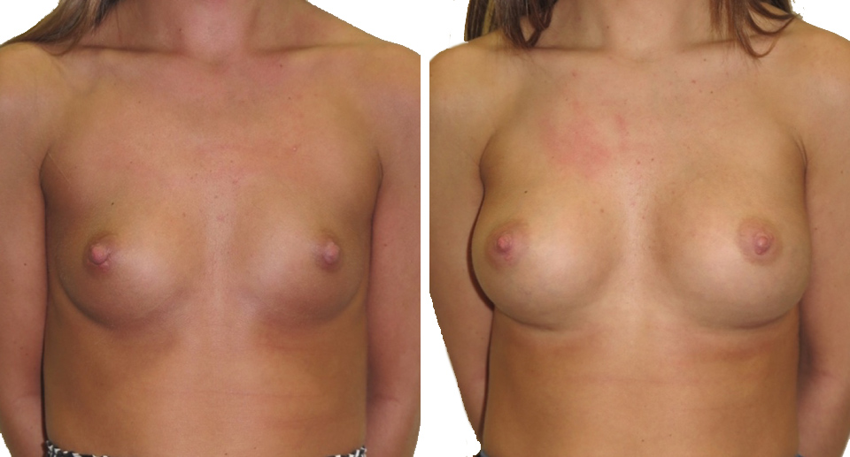 Breast Enlargement