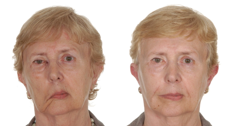 Surgery and Anti-wrinkle Injections for Facial Palsy