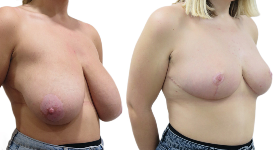 Breast Reduction