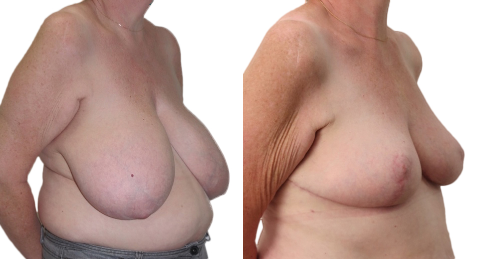 Breast Reduction