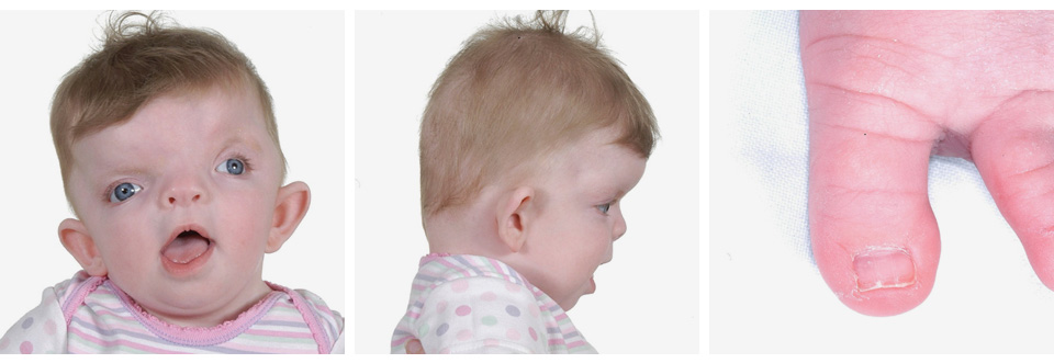 Craniofrontonasal dysplasia