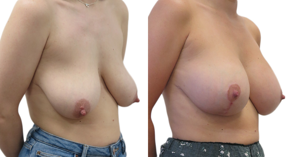 Breast Lift