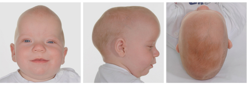 ERF related craniosynostosis