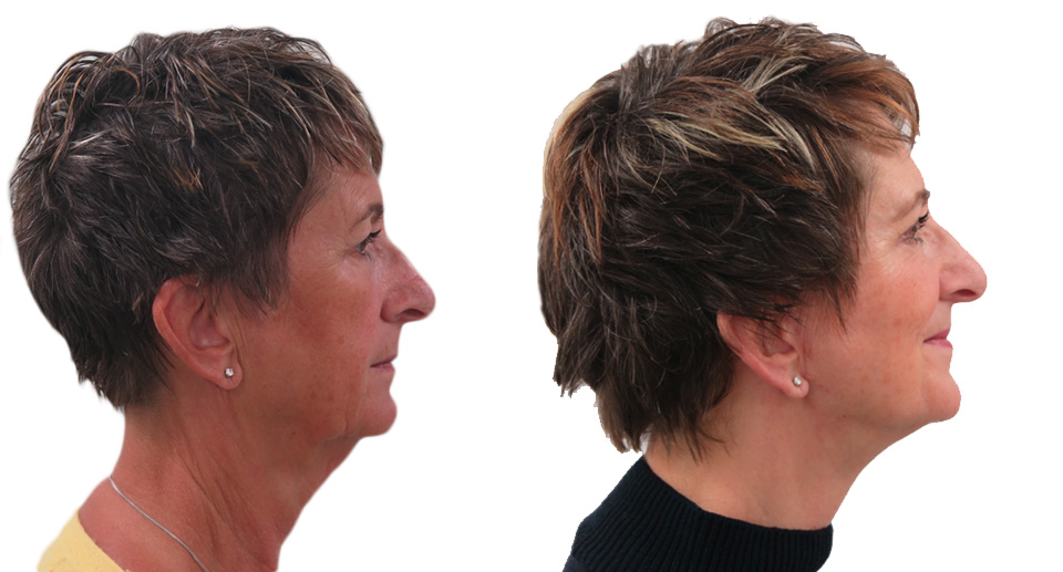 Facelift / Necklift