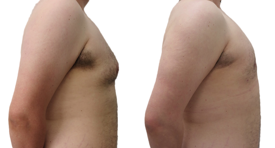 Male Breast Reduction