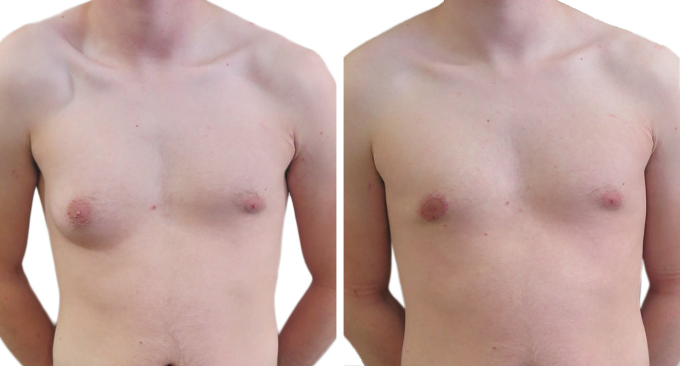 Male Breast Reduction