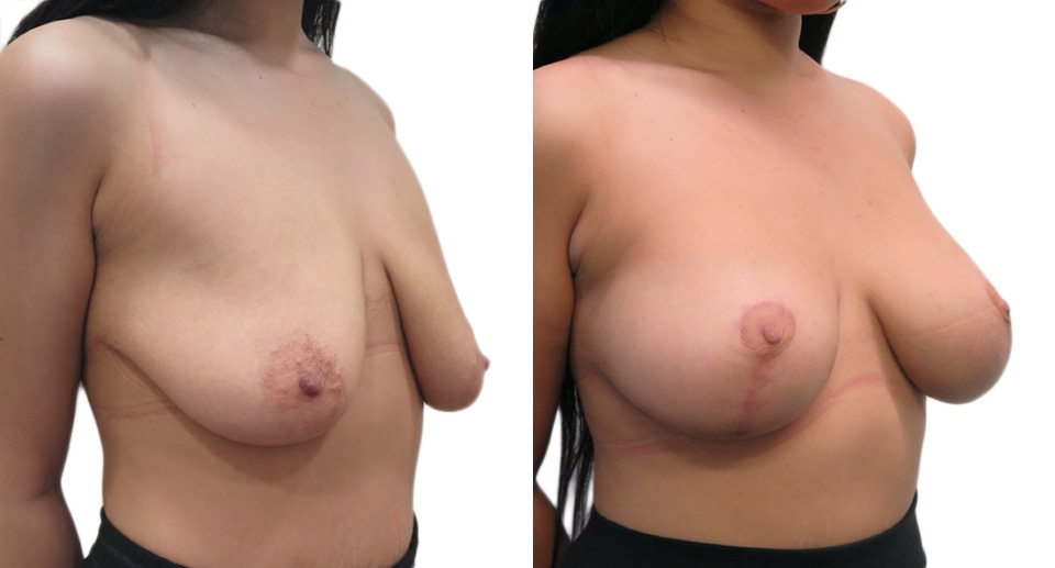 Breast Lift