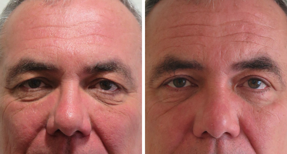 Eyelid Surgery