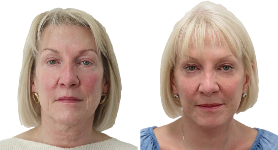 Facelift / Necklift