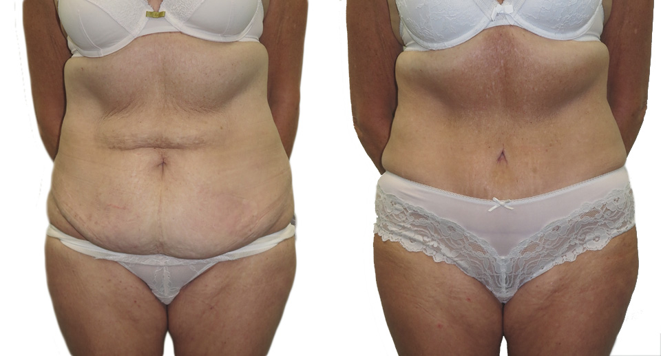 Tummy Tuck