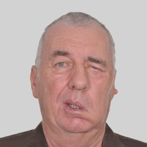 Surgery and Anti-wrinkle Injections for Facial Palsy