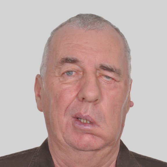 Surgery and Anti-wrinkle Injections for Facial Palsy