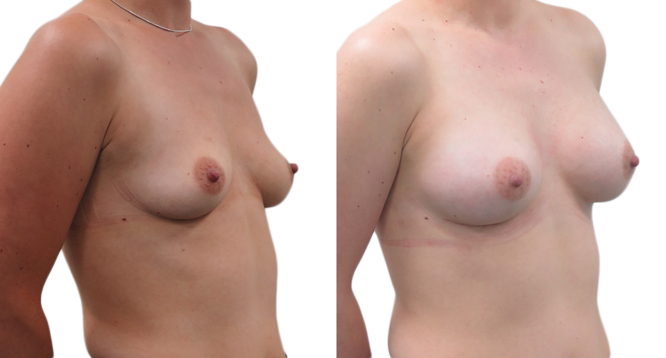 Breast Enlargement