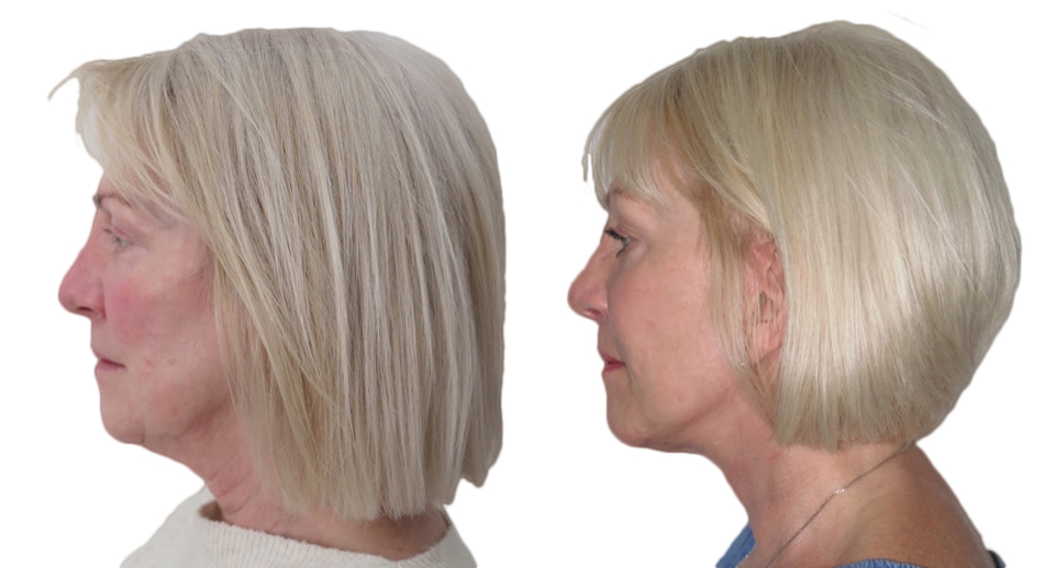 Facelift / Necklift