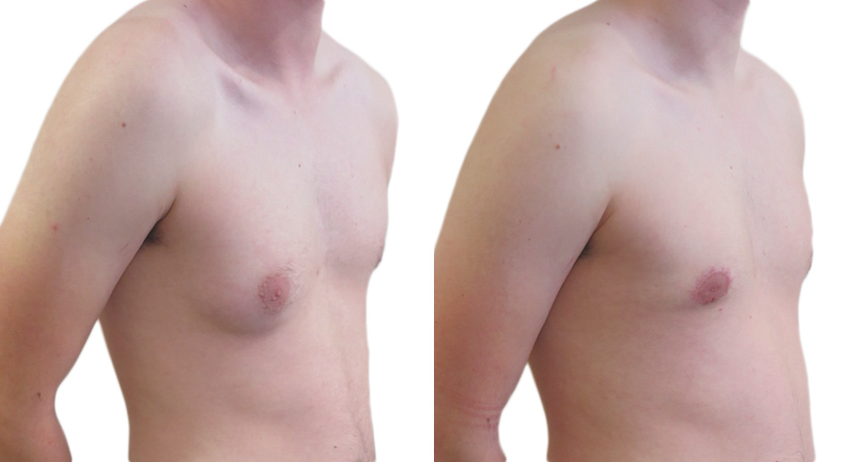 Male Breast Reduction