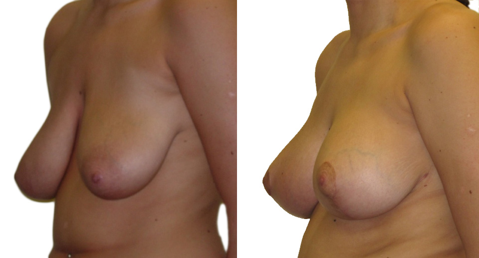 Breast Lift