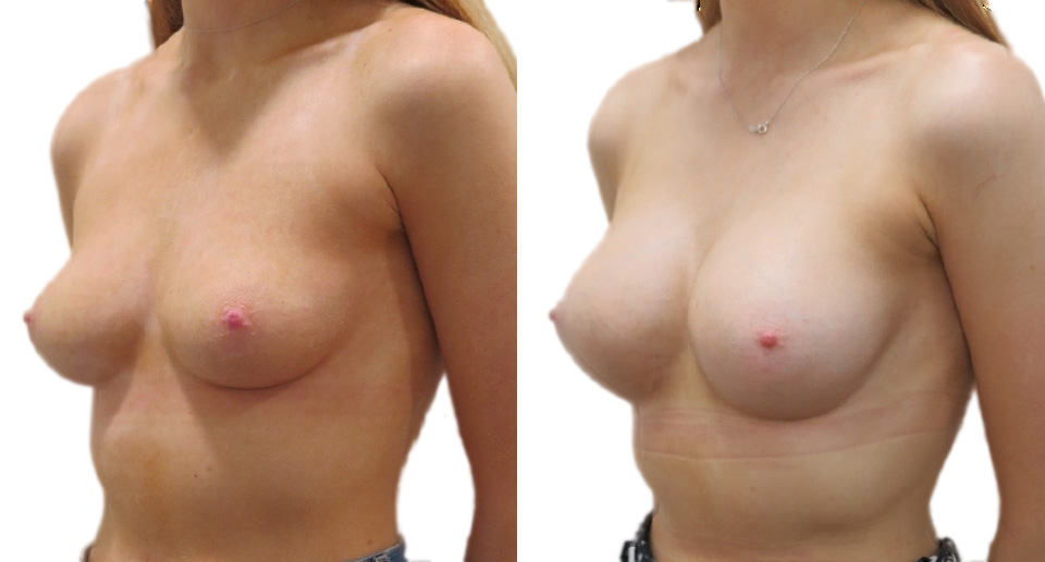 Breast Enlargement