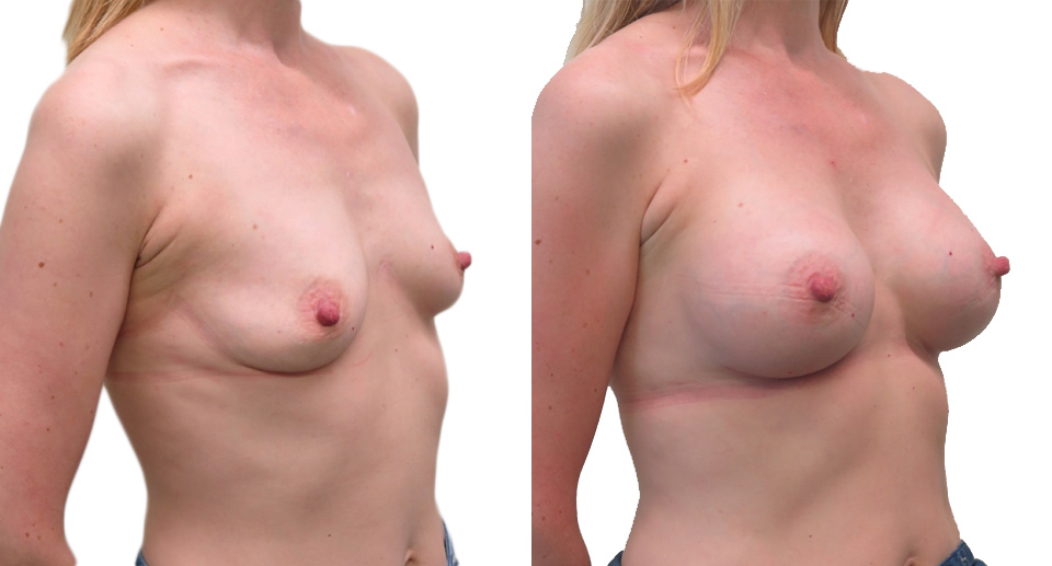 Breast Enlargement