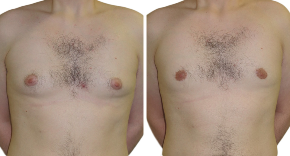 Male Breast Reduction