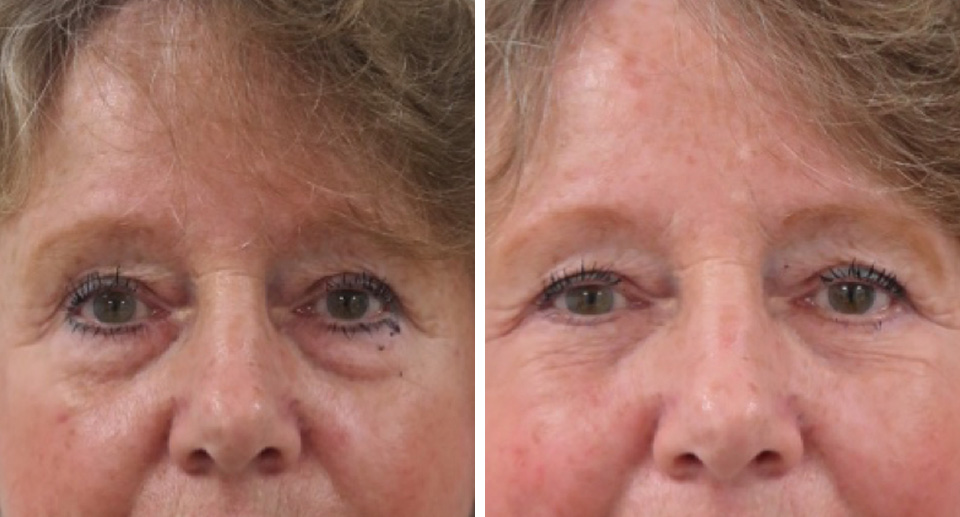 Eyelid Surgery