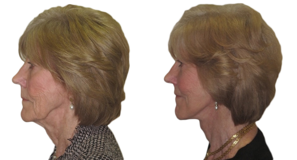 Facelift / Necklift