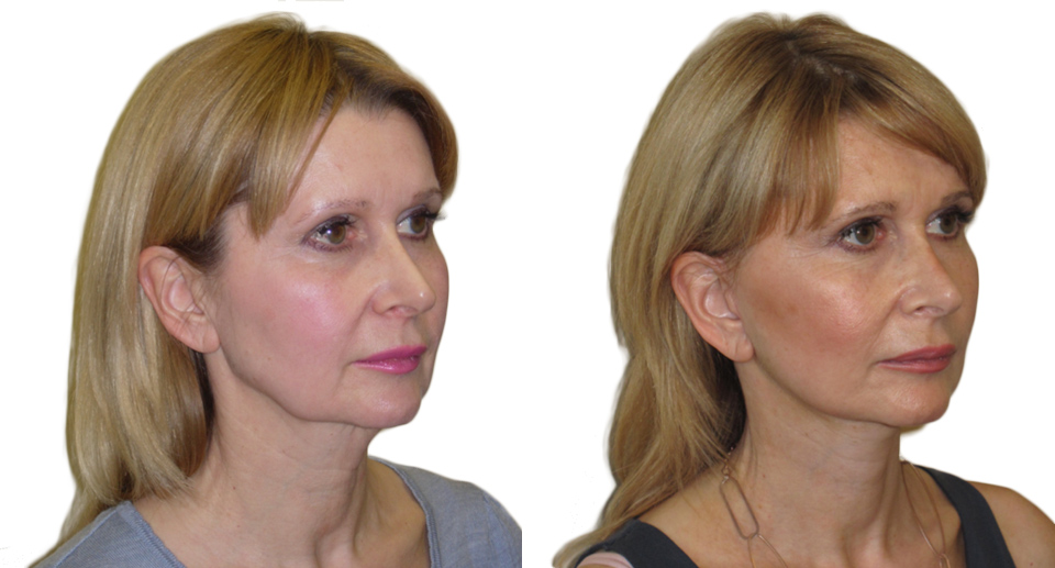 Facelift / Necklift