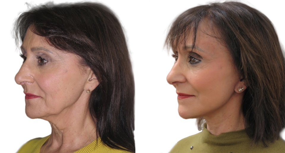 Facelift / Necklift