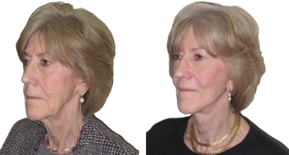 Facelift / Necklift