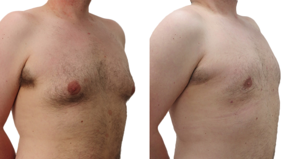 Male Breast Reduction