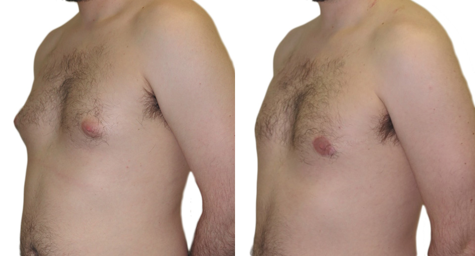 Male Breast Reduction