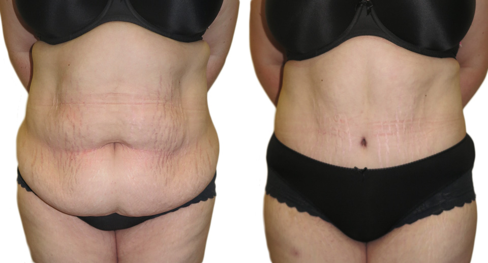 Tummy Tuck