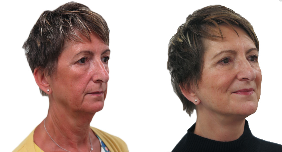 Facelift / Necklift