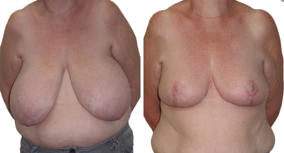 Breast Reduction