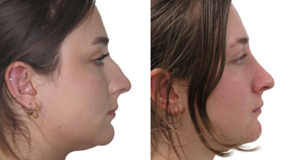 Nose Reshaping