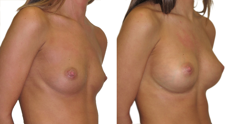 Breast Enlargement