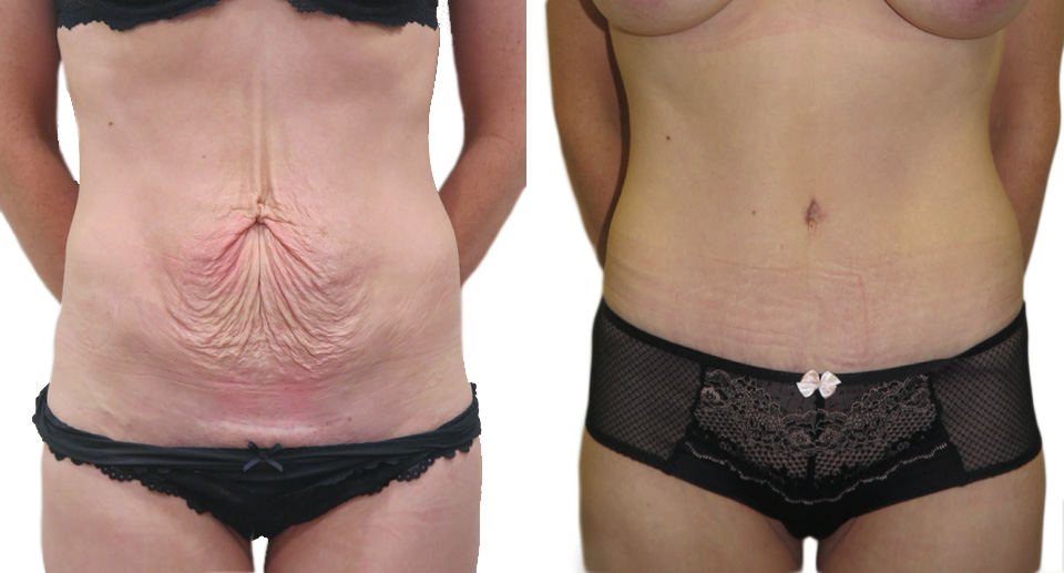 Tummy Tuck