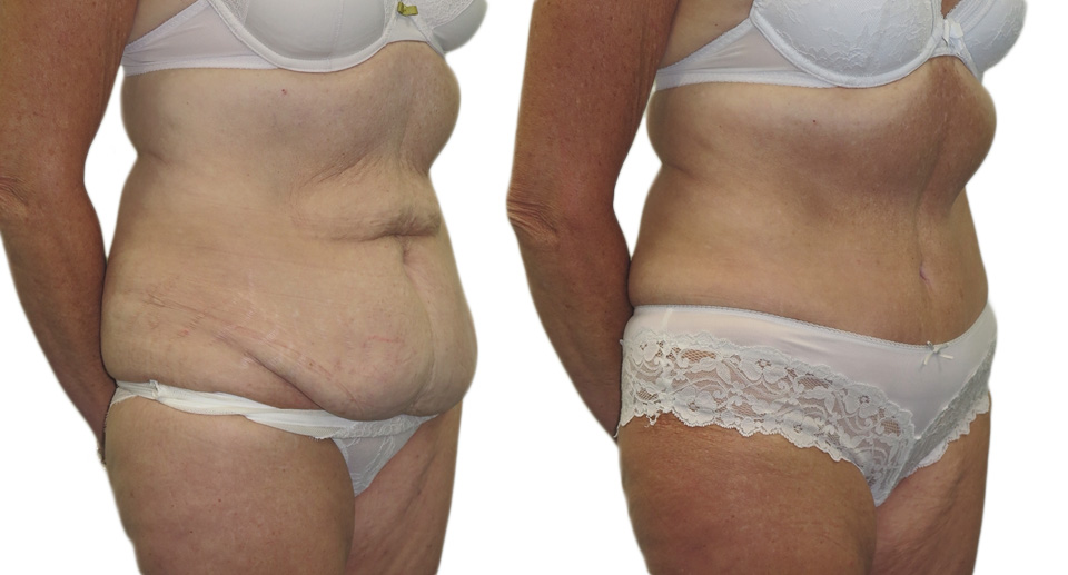 Tummy Tuck