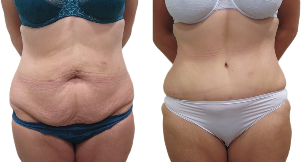 Tummy Tuck