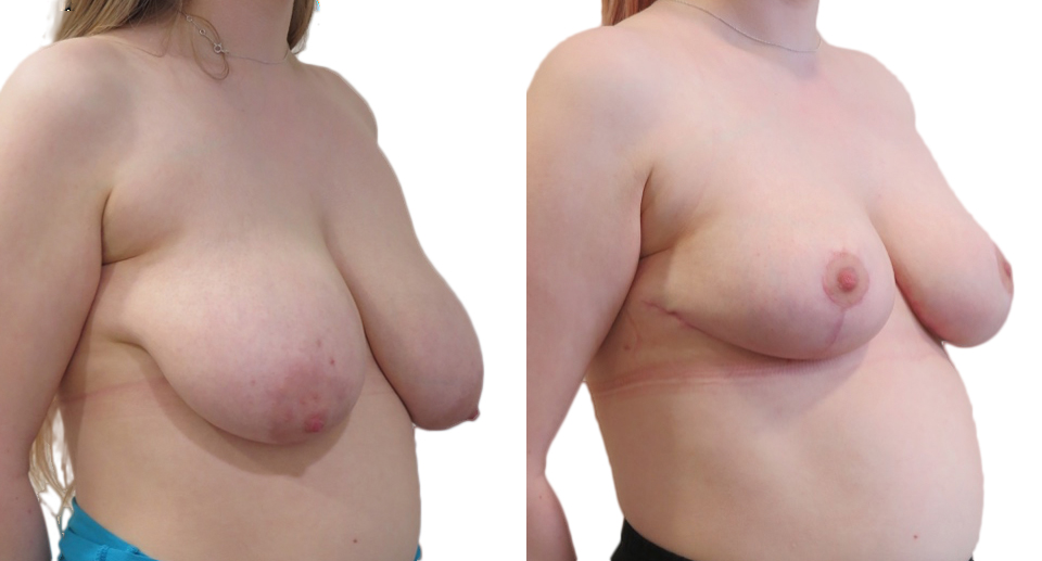 Breast Reduction