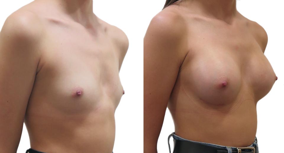 Breast Enlargement