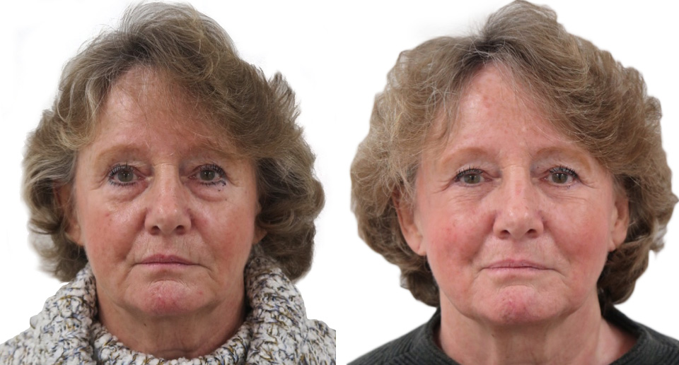 Eyelid Surgery